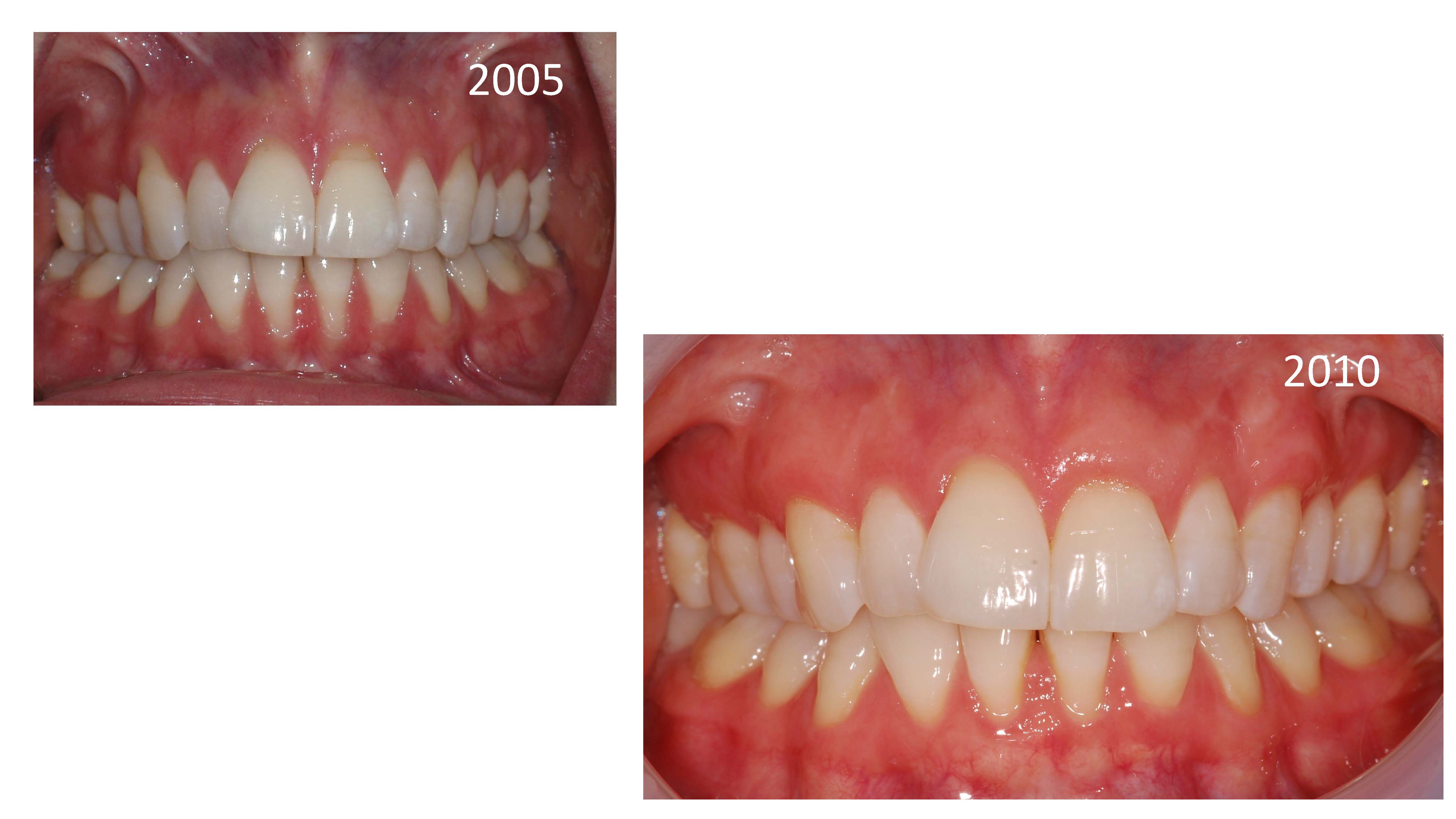 Understanding Gingival Recession Implant Dentist Chicago