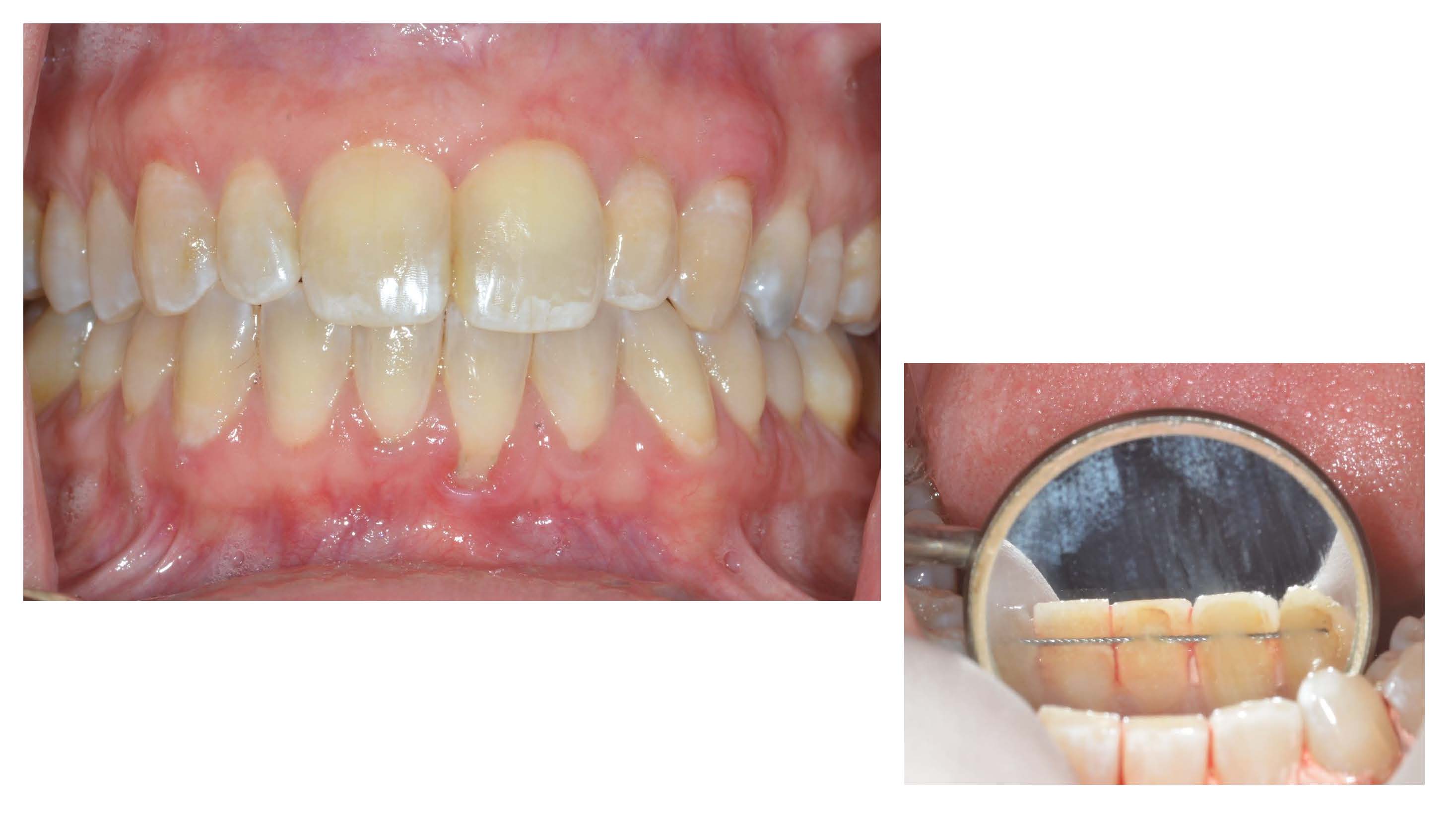 Recession and Permanent Orthodontic Retainers Implant Dentist Chicago