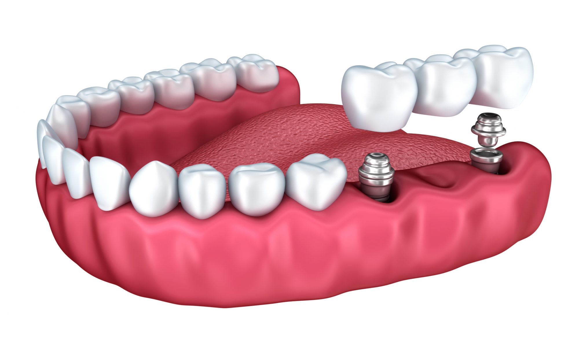 dental bridge implant